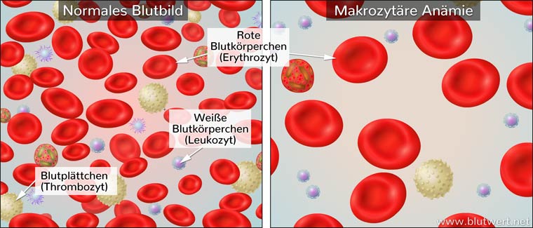 Makrozytäre Anämie