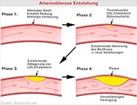Arteriosklerose Entstehung