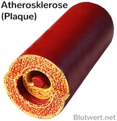 Arteriosklerose (Plaque)