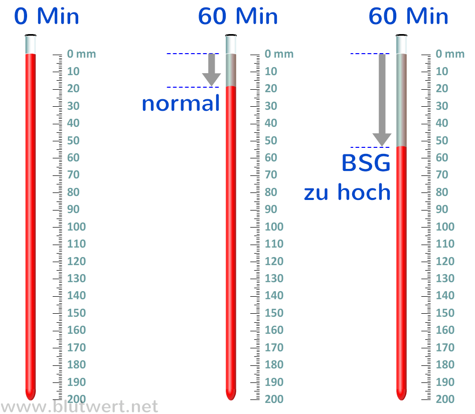 Erhöht was ist bedeutet wenn die es blutsenkung Blutsenkung •