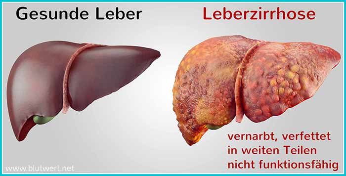 Leberzirrhose (rechts) im Vergleich zur gesunden Leber (links)