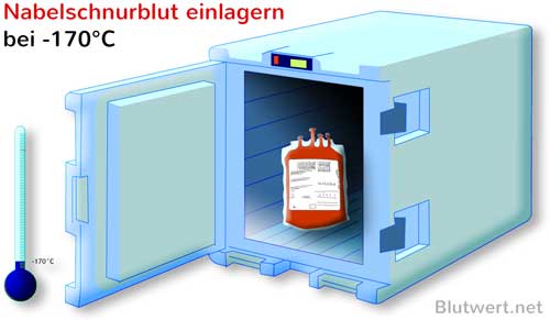 Nabelschnurblut einlagern