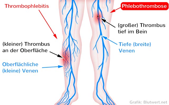 Phlebothrombose