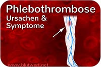 Phlebothrombose - Ursachen und Symptome