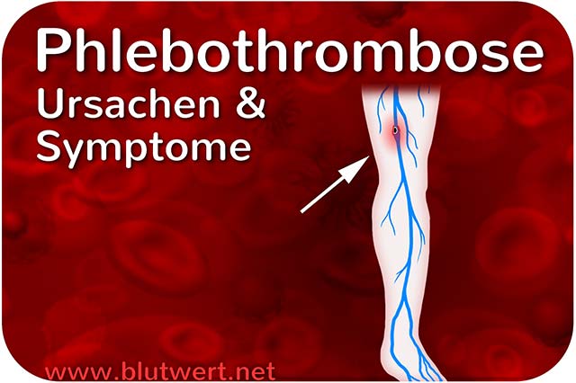 Phlebothrombose - Ursachen und Symptome