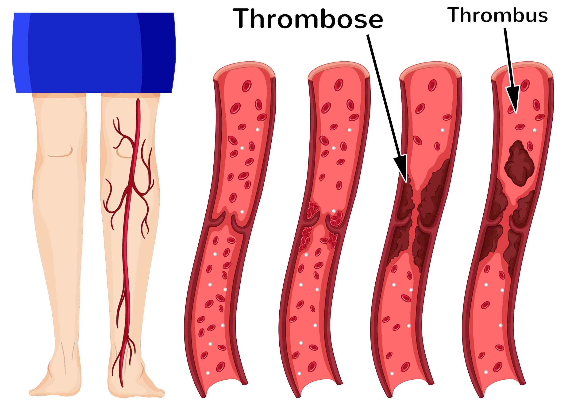 Ist oberflächliche was thrombophlebitis eine Was ist