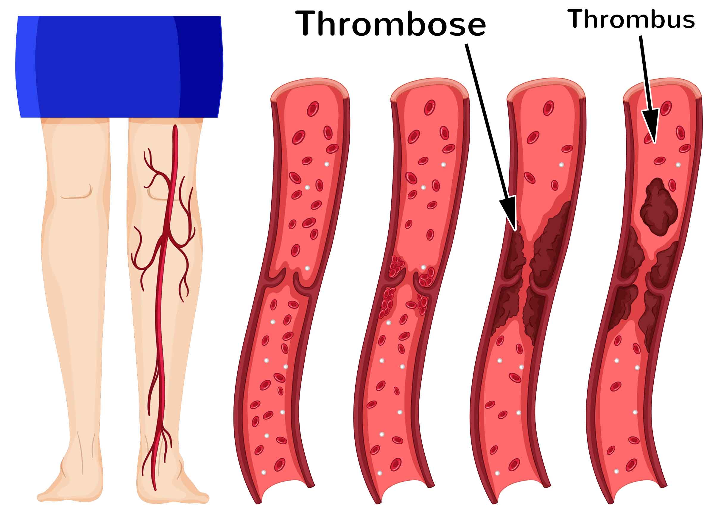 Тромбоз образование. Тромбоз кровеносных сосудов.