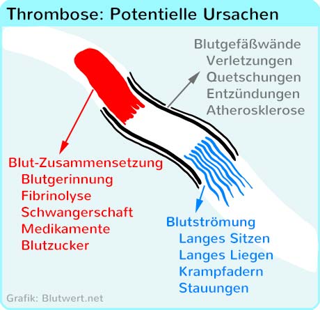 Potentielle Thrombose Ursache: Blut, Blutgefäß oder Blutfluss