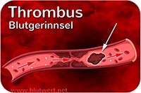 Thrombus (Blutgerinnsel)